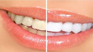 10 mẹo trắng răng cho nét đẹp hoàn thiện ngày Tết