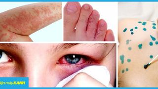 9 bệnh da liễu thường gặp trong mùa nồm và cách ngăn ngừa